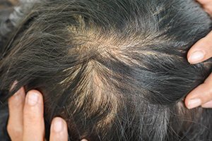female scale loosing hair