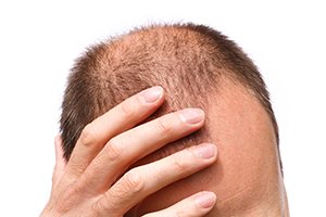 male who is loosing his hair