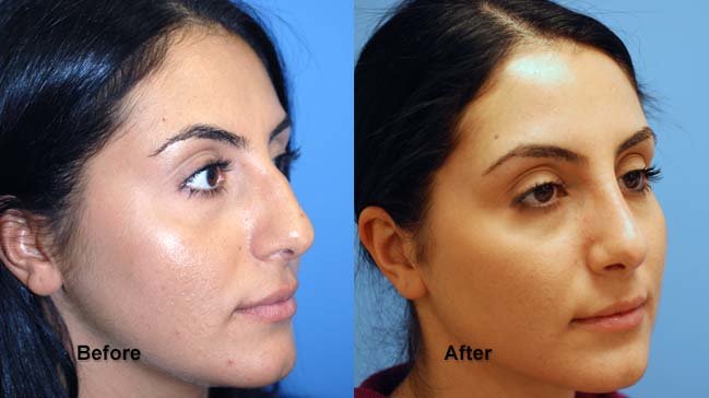 jones rhinoplasty 2