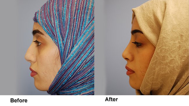 jones rhinoplasty 5