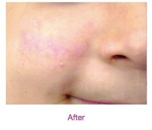 vbeam after photo 4