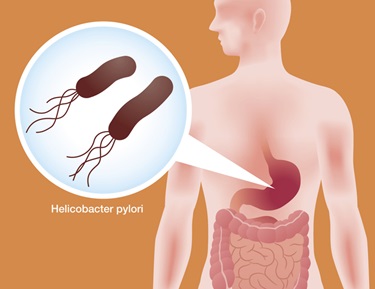 H. Pylori