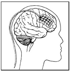 EPILEPSY 5PhaseII