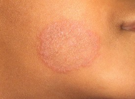 fungus ringworm face1 TAS