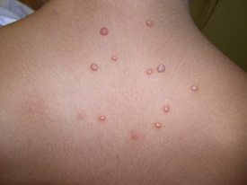 molluscum TAS