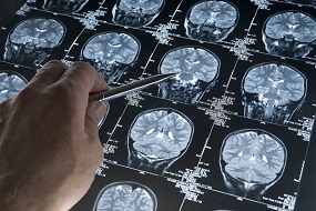 Imvax immunotherapy